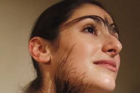 Lông rậm ở phụ nữ - Hình ảnh minh họa